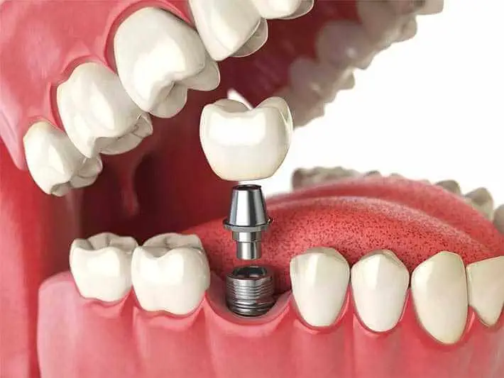 Fogászati implantátum - fogászat székesfehérvár
