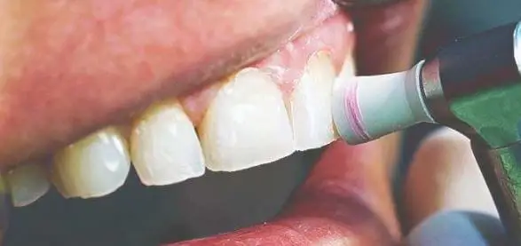 Fogkő eltávolítás székesfehérvár