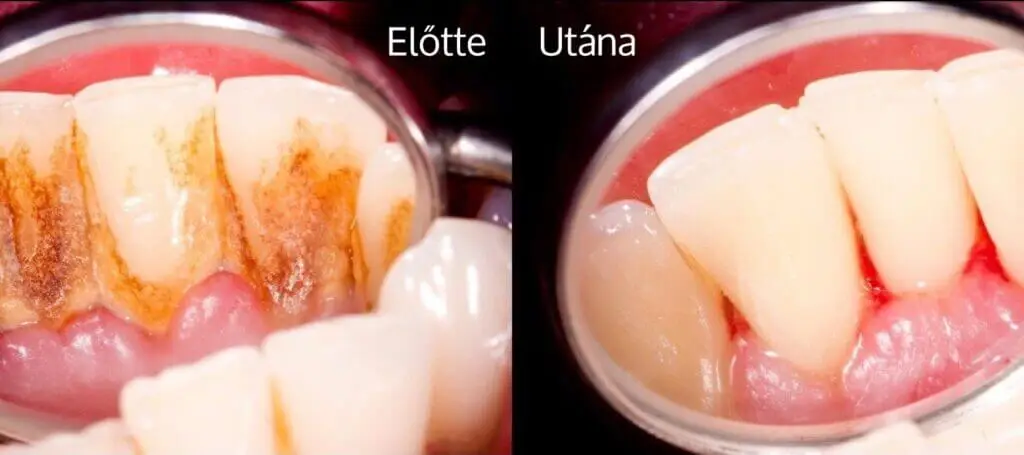 fogkőeltávolítás székesfehérvár fogászati rendelő