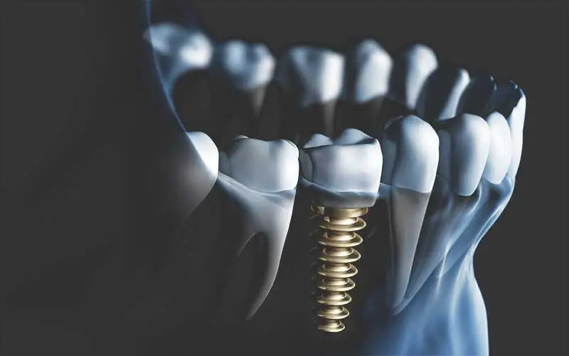 implantacio-ar