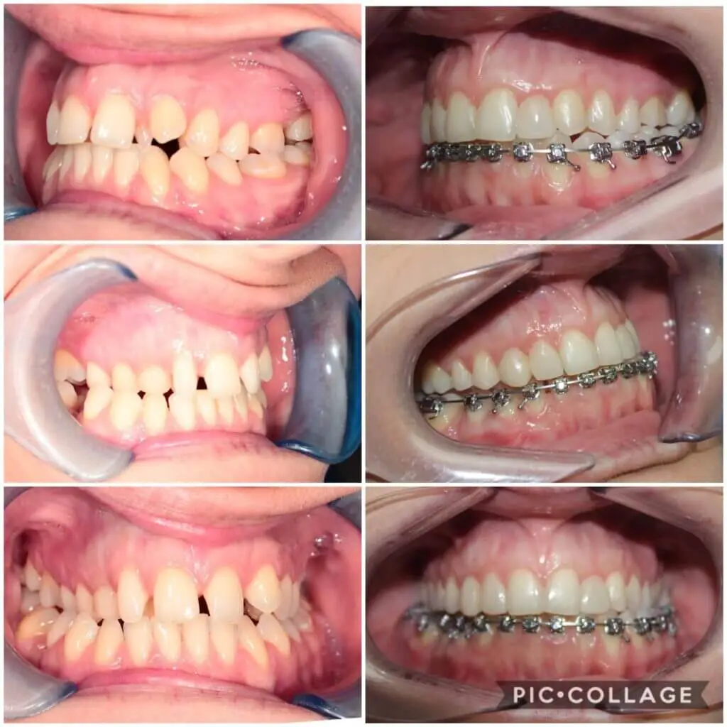 fogszabályozás előtte utána