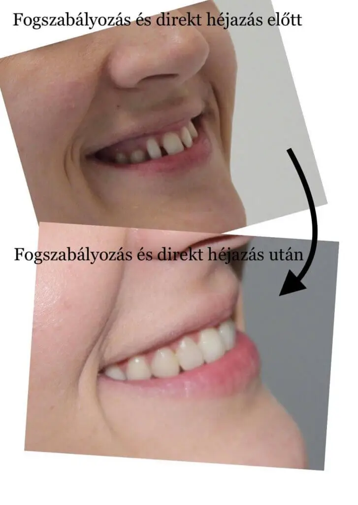 Fogszabályozás és direkt héj referencia előtte utána
