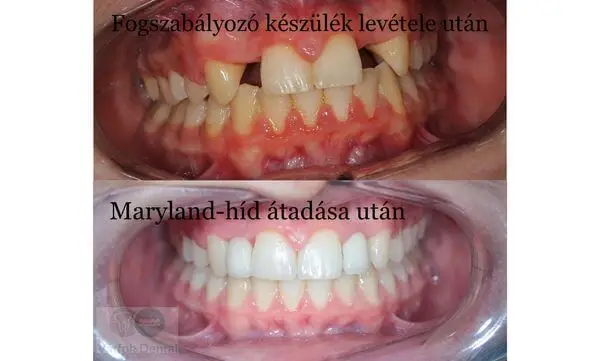 fogszabályozó készülék előtt - után