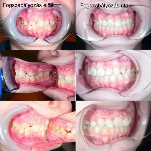 fogszabályozás előtte utána