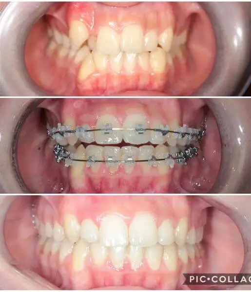 fogszabályozás előtte utána