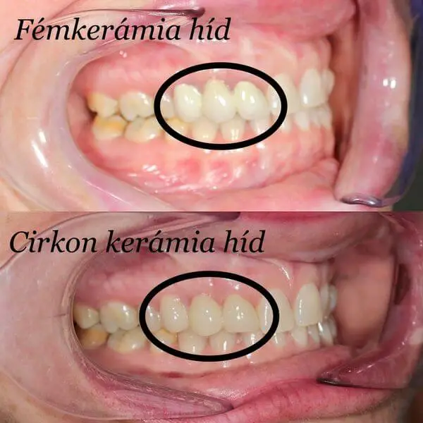 Fémkerámia hd eltte utána