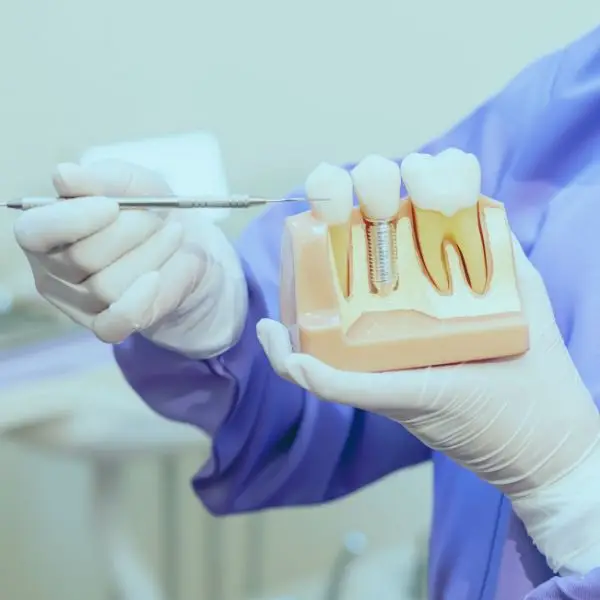 Fogpótlás típusa.